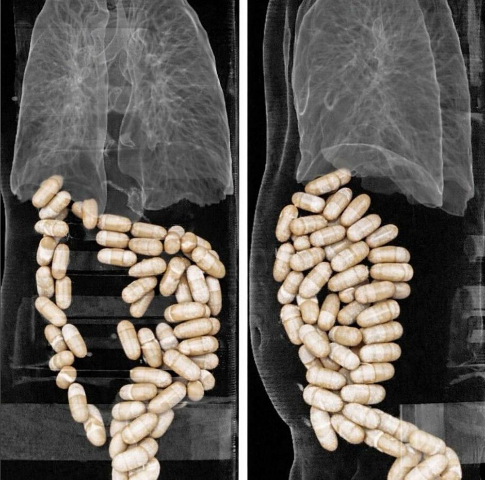 2 ş&uuml;phelinin midesinden 127 kaps&uuml;l uyuşturucu &ccedil;ıktı 