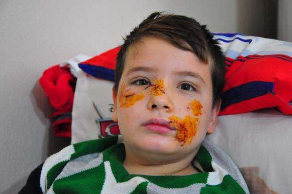 Köpek saldırısına uğrayan Mert'in yüzüne 60 dikiş atıldı